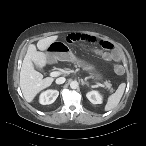 Adhesions within abdominal wall hernia (Radiopaedia 58283-65394 Axial C+ portal venous phase 26).png