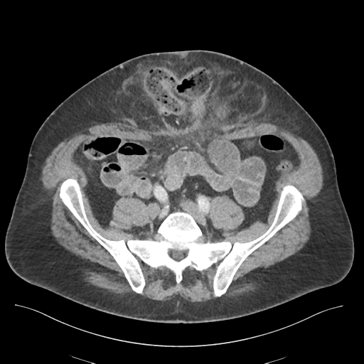 Adhesions within abdominal wall hernia (Radiopaedia 58283-65394 Axial C+ portal venous phase 59).png
