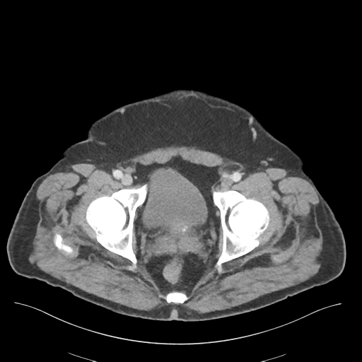 File:Adhesions within abdominal wall hernia (Radiopaedia 58283-65394 Axial C+ portal venous phase 79).png