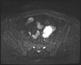 Adnexal multilocular cyst (O-RADS US 3- O-RADS MRI 3) (Radiopaedia 87426-103754 Axial DWI 36).jpg