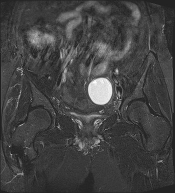 File:Adnexal multilocular cyst (O-RADS US 3- O-RADS MRI 3) (Radiopaedia 87426-103754 Coronal T2 fat sat 15).jpg
