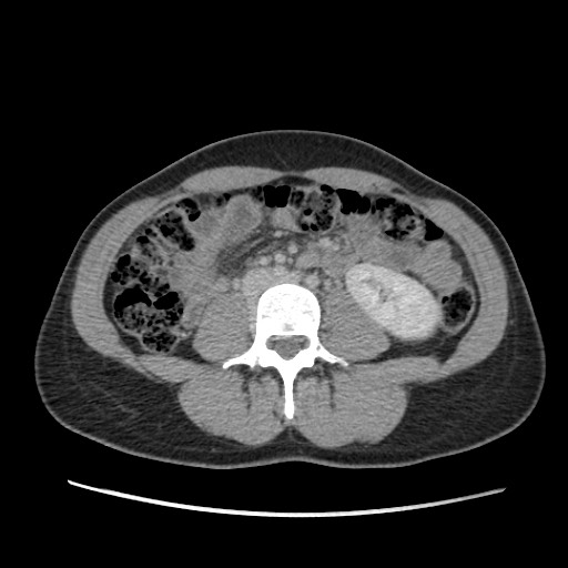 Adrenal cyst (Radiopaedia 64869-73813 Axial C+ portal venous phase 43).jpg