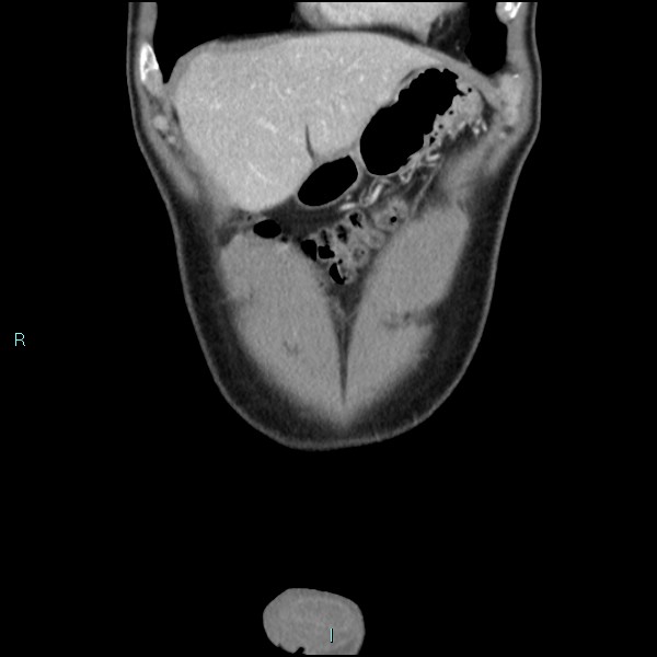 Adrenal cystic lymphangioma (Radiopaedia 83161-97534 Coronal C+ portal venous phase 14).jpg