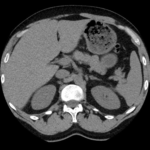 File:Adrenal gland trauma (Radiopaedia 81351-95079 Axial non-contrast 33).jpg