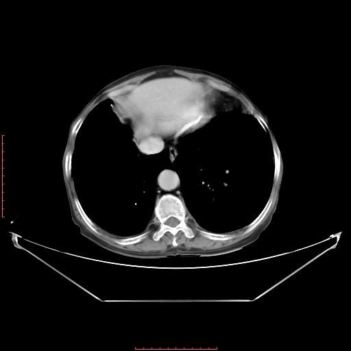 Adrenal hemangioma (Radiopaedia 68923-78668 Axial C+ portal venous phase 13).jpg
