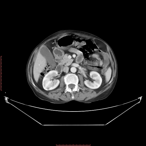 Adrenal hemangioma (Radiopaedia 68923-78668 Axial C+ portal venous phase 32).jpg