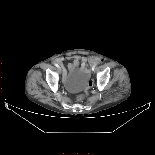 File:Adrenal hemangioma (Radiopaedia 68923-78668 Axial C+ portal venous phase 61).jpg