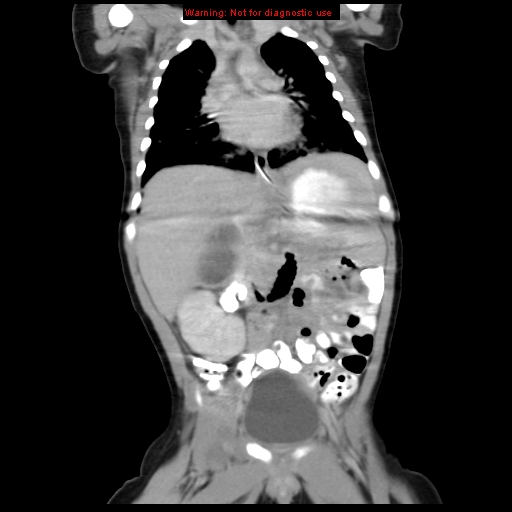 File:Adrenal hemorrhage (Radiopaedia 9390-10077 Coronal C+ portal venous phase 4).jpg
