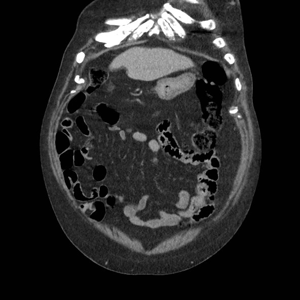 Adrenal lymphoma (Radiopaedia 84145-99415 Coronal C+ portal venous phase 13).jpg
