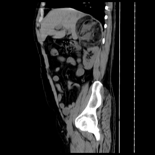 File:Adrenal myelolipoma (Radiopaedia 41843-44834 Sagittal non-contrast 12).jpg