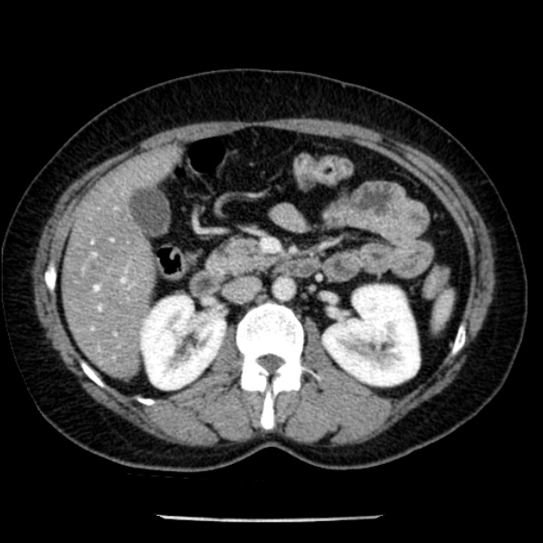 Adrenal myelolipoma (Radiopaedia 43401-46759 Axial C+ portal venous phase 34).jpg