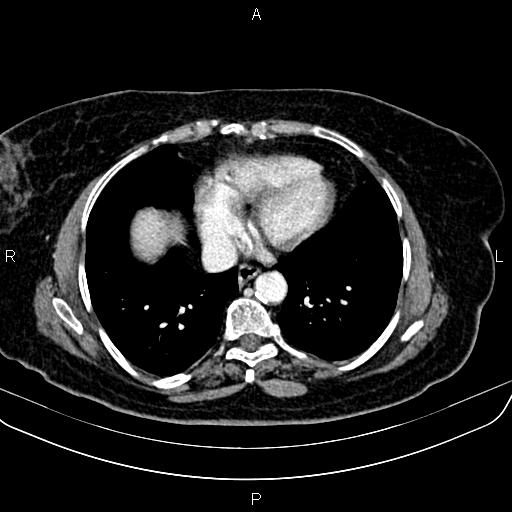 Adrenal myelolipoma (Radiopaedia 82742-96986 Axial renal cortical phase 8).jpg