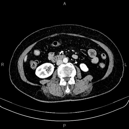 Adrenal myelolipoma (Radiopaedia 82742-96986 Axial renal cortical phase 92).jpg