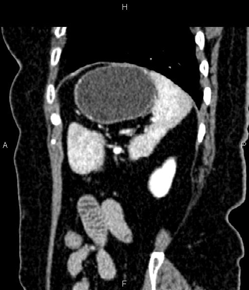 Adrenal myelolipoma (Radiopaedia 82742-96986 Sagittal renal cortical phase 86).jpg