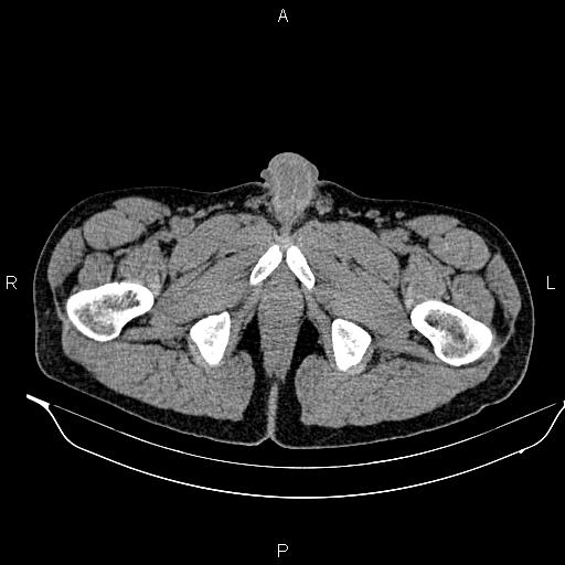File:Adrenal myelolipoma (Radiopaedia 87794-104246 Axial non-contrast 113).jpg