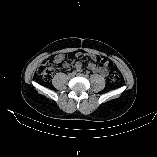 Adrenal myelolipoma (Radiopaedia 87794-104246 Axial non-contrast 69).jpg
