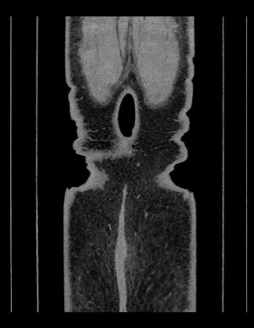 Adrenal myelolipoma - bilateral (Radiopaedia 74805-85810 Coronal C+ portal venous phase 35).jpg