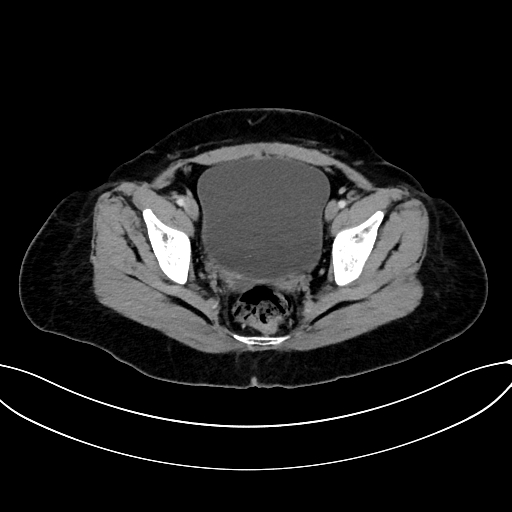 Adrenocortical carcinoma (Radiopaedia 87281-103569 Axial C+ portal venous phase 77).jpg