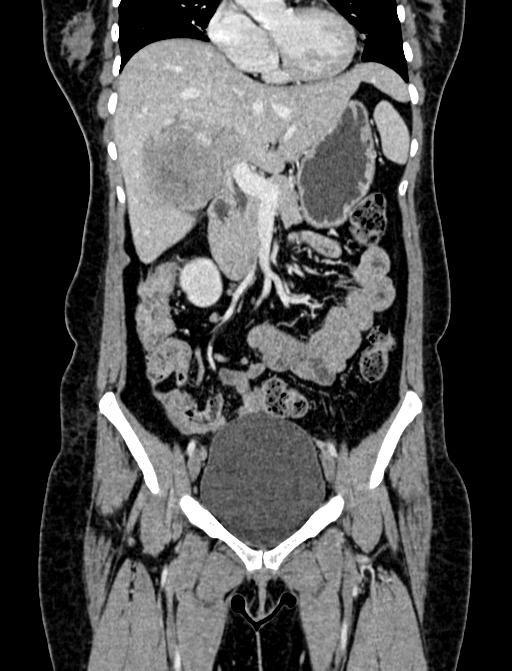 Adrenocortical carcinoma (Radiopaedia 87281-103569 Coronal C+ portal venous phase 17).jpg