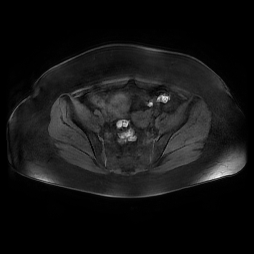 File:Adult granulosa cell tumor of the ovary (Radiopaedia 64991-73953 axial-T1 Fat sat post-contrast dynamic 12).jpg
