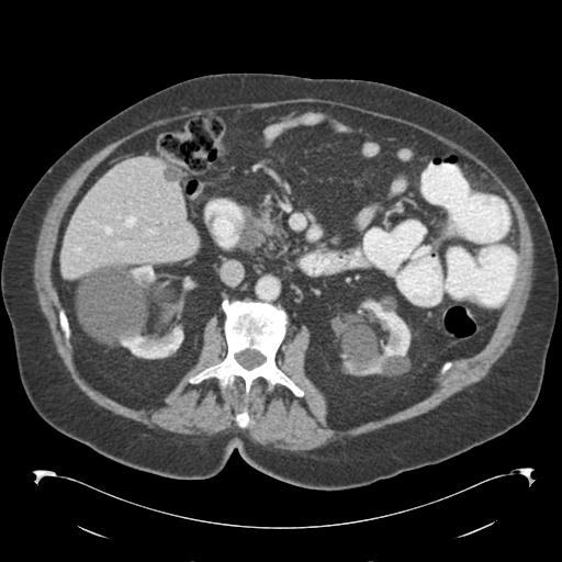 Adult ileal intussusception with secondary obstruction (Radiopaedia 30395-31051 Axial C+ portal venous phase 32).jpg