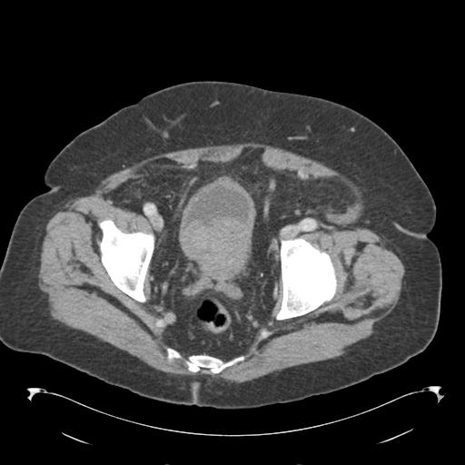 Adult ileal intussusception with secondary obstruction (Radiopaedia 30395-31051 Axial C+ portal venous phase 69).jpg