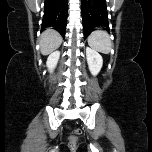 File:Afferent loop syndrome - secondary to incarcerated trocar site hernia (Radiopaedia 82959-97305 Coronal C+ portal venous phase 111).jpg