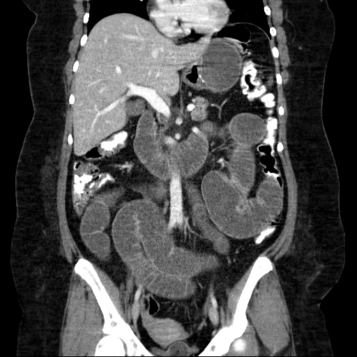 File:Afferent loop syndrome - secondary to incarcerated trocar site hernia (Radiopaedia 82959-97305 Coronal C+ portal venous phase 81).jpg