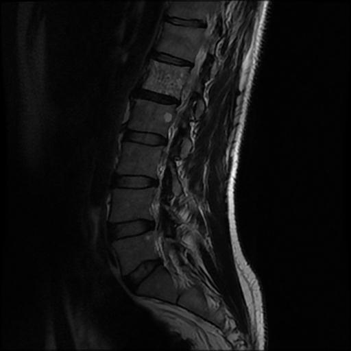 File:Aggressive vertebral hemangioma with pathological fracture (Radiopaedia 69528-79411 Sagittal T2 7).jpg