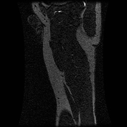 Alveolar soft part sarcoma (Radiopaedia 64501-73678 D 32).jpg