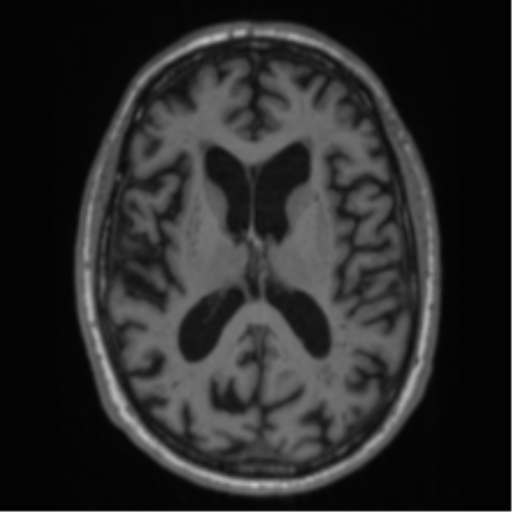 Alzheimer's disease- with Gerstmann syndrome and dressing apraxia (Radiopaedia 54882-61150 Axial T1 42).png