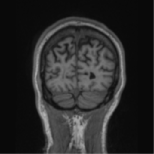 File:Alzheimer's disease- with apraxia (Radiopaedia 54763-61011 Coronal T1 18).png
