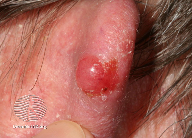 File:Amelanotic nodular melanoma (DermNet NZ MMamelanotic2).jpg