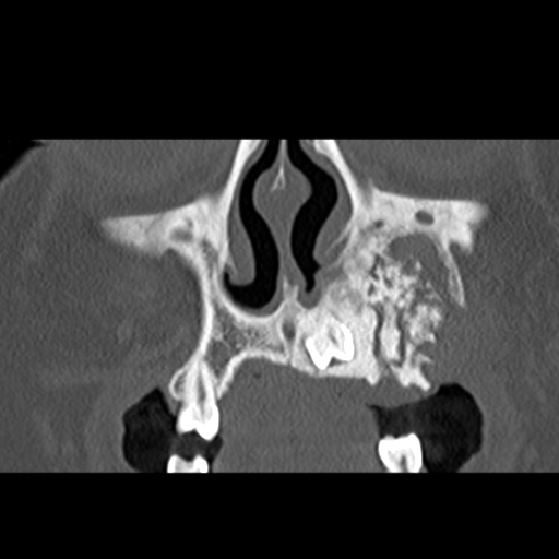 File:Ameloblastic fibro-odontoma (Radiopaedia 18843-18780 B 9).jpg