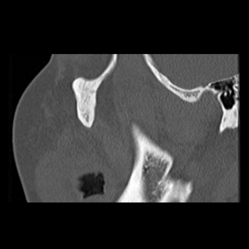 File:Ameloblastic fibro-odontoma (Radiopaedia 18843-18780 bone window 15).jpg
