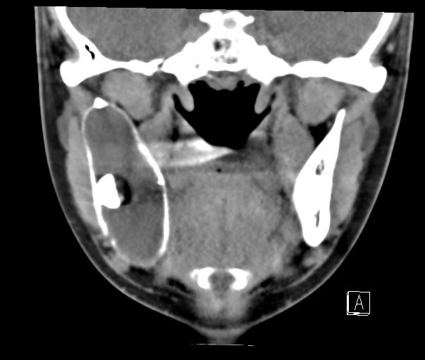 File:Ameloblastoma (Radiopaedia 26645-26793 Coronal C+ delayed 9).jpg