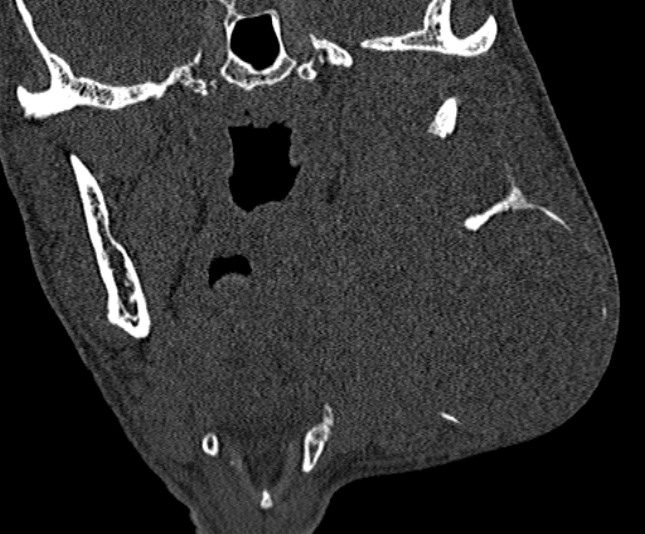 Ameloblastoma (Radiopaedia 51921-57766 Coronal bone window 155).jpg