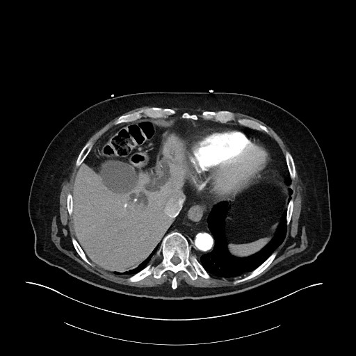 Ampullary adenocarcinoma (Radiopaedia 59373-66734 A 35).jpg