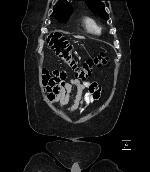 Ampullary adenocarcinoma (Radiopaedia 59373-66734 D 6).jpg