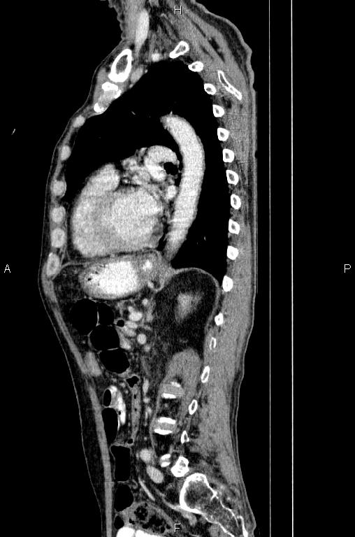 Ampullary adenocarcinoma (Radiopaedia 86093-102033 E 59).jpg