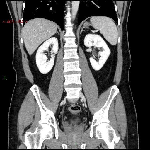 Ampullary carcinoma (Radiopaedia 56396-63056 E 63).jpg