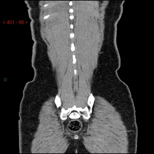 Ampullary carcinoma (Radiopaedia 56396-63056 E 85).jpg
