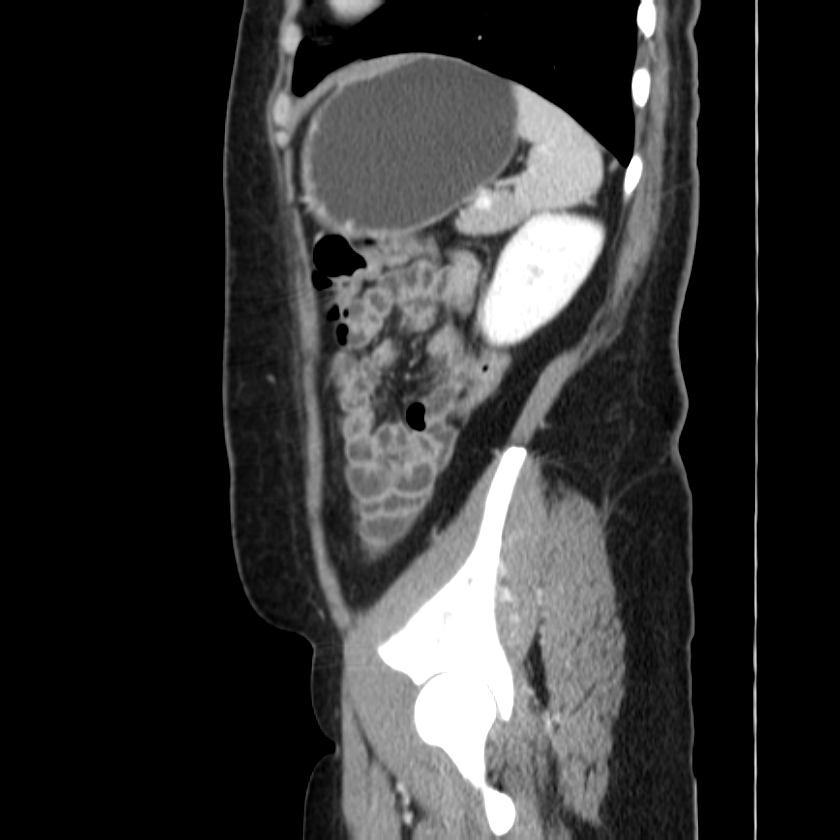 Ampullary tumor (Radiopaedia 22787-22816 D 44).jpg