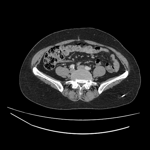 Ampullary tumor (Radiopaedia 60333-67998 A 58).jpg
