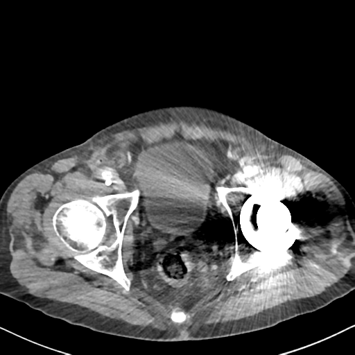 File:Amyand hernia (Radiopaedia 39300-41547 A 68).png