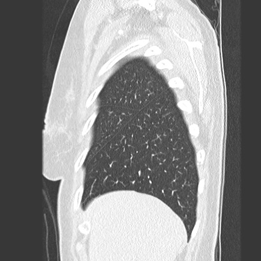 Amyloidosis - bronchial and diffuse nodular pulmonary involvement (Radiopaedia 60156-67745 Sagittal lung window 12).jpg