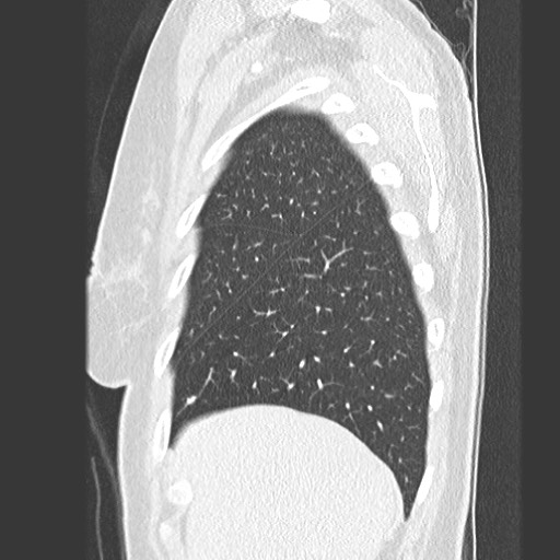 Amyloidosis - bronchial and diffuse nodular pulmonary involvement (Radiopaedia 60156-67745 Sagittal lung window 13).jpg