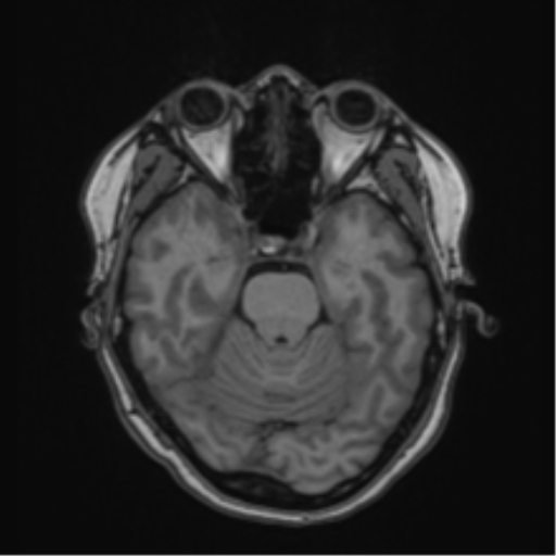 Anaplastic astroblastoma (Radiopaedia 55666-62194 Axial T1 25).png