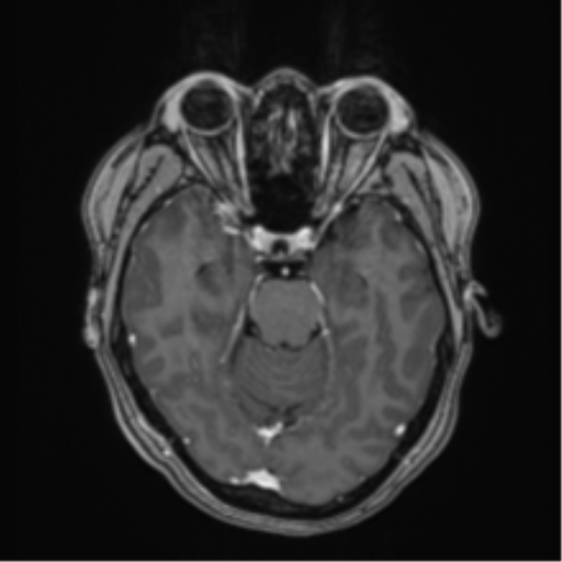 Anaplastic astroblastoma (Radiopaedia 55666-62194 Axial T1 C+ 27).png