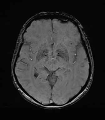 Anaplastic astrocytoma (Radiopaedia 86943-103160 Axial SWI 43).png